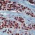 Formalin-fixed, paraffin-embedded human breast carcinoma stained with Heat Shock Protein 90-alpha Ab (Cat.AP00517) using peroxidase-conjugate and AEC chromogen. Note cytoplasmic and nuclear staining of tumor cells.