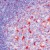 AP00590SU-N S100A6 antibody staining of Formalin-Fixed, Paraffin-Embedded Human tonsil using peroxidase-conjugate and AEC chromogen. Note cytoplasmic staining of cells in germinal center.