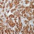 Formalin-fixed, paraffin-embedded human breast carcinoma stained with HSP70 Ab (Cat. AM00253) using peroxidase-conjugate and DAB chromogen. Note cytoplasmic and nuclear staining of tumor cells.