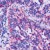 Formalin-fixed, paraffin-embedded human pancreatic tumor stained with TIMP-2 Ab (Cat. AM00260) using peroxidase-conjugate and AEC chromogen. Note cytoplasmic staining of tumor cells.