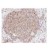 Immunohistochemistry of Rabbit Anti-Akt pSer473 Antibody Cat.-No R1465. 
Tissue: Human breast carcinoma. 
Fixation: Formalin Fixed Paraffin embedded. 
Antigen retrieval: not required. 
Primary antibody: Akt pS473 antibody at 100 dilution for 1 h at RT. Secondary antibody: Techmate streptavidin-biotin reagents at 1/10,000 for 45 min at RT. 
Localization: Akt pS473 is nuclear and occasionally cytoplasmic