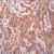 FFPE Human breast carcinoma stained with anti-STAT2 (Cat. AP00610) using peroxide conjugate and AEC chromogen. Note: Cytoplasmic staining.