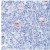Formalin-fixed, paraffin-embedded human Hodgkin’s lymphoma stained with Cat. AM00285PU-N using peroxidase-conjugate and AEC chromogen. Note cell membrane staining of Reed-Sternberg cells.