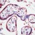 Formalin-fixed, paraffin-embedded human placenta stained with MMP-1 (AP00545PU-N) using peroxidase-conjugate and AEC chromogen. Note cytoplasmic staining of trophoblasts
