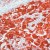 Formalin-fixed, paraffin-embedded human melanoma stained with S-100 (AP00594SU-N  using peroxidase-conjugate and AEC chromogen. Note intense cytoplasmic staining of tumor cells.