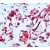 Formalin fixed paraffin embedded human angiosarcoma stained with Flt-1 antibody DP077 / DP077-05