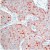 Formalin-fixed, paraffin-embedded human breast carcinoma stained with AM00492PU-N using peroxidase-conjugate and AEC chromogen. Note cytoplasmic staining of tumor cells.