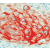 Formalin fixed paraffin embedded human squamous cell carcinoma stained with Cytokeratin 17 antibody DM127