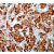 Formalin fixed paraffin embedded human breast carcinoma stained with Heat shock protein 70 antibody. DM3097S