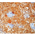 Formalin fixed paraffin embedded human melanoma stained with S-100 antibody. DM377