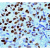 Formalin fixed paraffin embedded human Breast carcinoma stained with Progesterone Receptor using ABC and DAB chromogen. DP146
