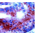 Formalin fixed paraffin embedded human Colon carcinoma stained with THR a1/a2 antibody DP149 using ABC and AEC chromogen