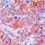 Formalin-fixed, paraffin-embedded human breast cancer stained with Prolactin Receptor (AM00543PU-N) using peroxidase-conjugate and AEC chromogen. Note cell membrane and cytoplasmic staining of tumor cells.