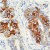 Formalin-fixed, paraffin-embedded human breast carcinoma stained with Keratin 8 (AM00550PU-N) using peroxidase-conjugate and DAB chromogen. Note cytoplasmic staining of tumor cells.