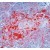 Formalin fixed paraffin embedded human squamous cell carcinoma of lung stained with Cytokeratin Pan antibody BM4068S / BM4068S-05