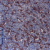 Figure 1. SP2091P S100 antibody staining of Formalin Fixed, Paraffin Human melanoma processed tissue.