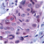 Formalin Fixed,Paraffin Human breast carcinoma sections stained with PUMA Antibody Cat.-No Cat.-No SP1410P at 10 µg/ml.