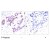 Figure 1. Immunohistochemical analysis of paraffin-embedded human breast carcinoma tissue using STAT1 (phospho-Tyr701) antibody AP02343PU.