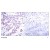 Figure 1. Immunohistochemical analysis of paraffin-embedded human breast carcinoma tissue using STAT6 (phospho-Thr645) antibody AP02350PU.