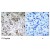 Immunohistochemical analysis of paraffin- embedded human breast carcinoma tissue, using Akt (phospho-Ser473) antibody AP02353PU.