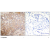 Immunohistochemical analysis of paraffin-embedded human breast carcinoma tissue using Keratin 18 antibody (AP02537PU-S; AP02537PU-N).
