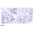 Immunohistochemical analysis of paraffin-embedded human breast carcinoma tissue using STAT1 antibody.