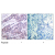 Figure 1. Immunohistochemical analysis of paraffin-embedded human breast carcinoma tissue using BCL2 Antibody (#AP02600PU) (Left) or the same antibody preincubated with blocking peptide (Right).