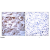 Immunohistochemical analysis of paraffin-embedded human breast carcinoma tissue using BCL-2 antibody.