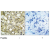 Figure 1. Immunohistochemical analysis of paraffin-embedded human breast carcinoma tissue using VEGFR2 antibody (AP02619PU) (Left) and the same antibody preincubated with blocking peptide (Right).