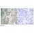 Figure 1. Immunohistochemical analysis of paraffin-embedded human breast carcinoma tissue, using VEGFR2 (phospho-Tyr1214) antibody (AP02383PU).