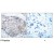 Figure 1. Immunohistochemical analysis of paraffin- embedded human breast carcinoma tissue using VEGFR2 (phospho-Tyr951) antibody (AP02384PU).