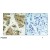 Figure 1. Immunohistochemical analysis of paraffin-embedded human lung carcinoma tissue using Akt2 antibody AP02678PU.