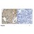 Figure 1. Immunohistochemical analysis of paraffin-embedded human breast carcinoma tissue using STAT1 antibody AP02695PU.