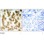 Immunohistochemical analysis of paraffin-embedded human breast carcinoma tissue using Keratin 8 antibody.