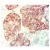 RCK102 Cytokeratin staining of a human squamous cell carcinoma of the lung.
