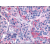 AP07034PU-N Calcitonin Receptor antibody Staining of Formalin-Fixed Paraffin-Embedded Human Thyroid, medullary carcinoma at 20 µg/ml followed by biotinylated Goat anti-Rabbit IgG secondary antibody, Alkaline Phosphatase-streptavidin and Chromogen.