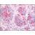 Breast carcinoma: Formalin-Fixed Paraffin-Embedded (FFPE)