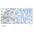 Figure 1. Immunohistochemical analysis of paraffin-embedded human breast carcinoma tissue using AKT1/AKT2/AKT3 (Phospho-Tyr315/316/312) Antibody (#AP08030PU).