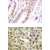 Immunohistochemistry (IHC) analysis of p-Androgen Receptor (pSer213) antibody in paraffin-embedded human prostate carcinoma tissues