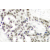 Immunohistochemistry (IHC) analysis of p-Androgen Receptor (pSer650) antibody in paraffin-embedded human breast carcinoma tissue.