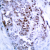 Immunohistochemistry (IHC) analysis of p-BCL-2 (pSer70) antibody in paraffin-embedded human breast carcinoma tissue.