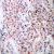Immunohistochemistry (IHC) analysis of p-BCL-2 (pThr56) antibody in paraffin-embedded human breast carcinoma tissue.
