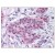 Formalin-Fixed Paraffin-Embedded (FFPE): Breast Carcinoma, stained with AP03053PU-N.
