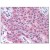 Formalin-Fixed Paraffin-Embedded (FFPE): Breast Carcinoma, stained with AP03054PU-N.