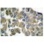 Immunohistochemistry analysis in paraffin-embedded human breast carcinoma tissue using Cytokeratin 16 antibody Cat.-No. AP06197PU-N.