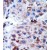 Formalin-fixed and paraffin-embedded human cancer tissue reacted with the primary antibody, which was peroxidase-conjugated to the secondary antibody, followed by DAB staining.