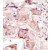 Formalin-fixed and paraffin-embedded human cancer tissue reacted with the primary antibody, which was peroxidase-conjugated to the secondary antibody, followed by DAB staining.