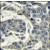 Formalin-fixed and paraffin-embedded human breast carcinoma reacted with AKT3 Antibody (N-term), which was peroxidase-conjugated to the secondary antibody, followed by DAB staining.