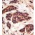 Formalin-fixed and paraffin-embedded human cancer tissue reacted with the primary antibody, which was peroxidase-conjugated to the secondary antibody, followed by DAB staining.