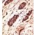 Formalin-fixed and paraffin-embedded human cancer tissue reacted with the primary antibody, which was peroxidase-conjugated to the secondary antibody, followed by DAB staining.
